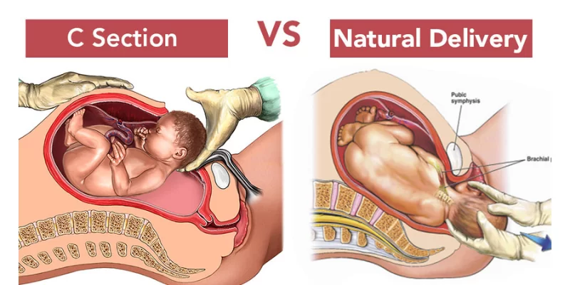 Caesarian vs Normal delivery Which one is safer - Health Blog - Yatharth Hospitals