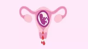 CHẢY MÁU ÂM ĐẠO KHI CÓ THAI