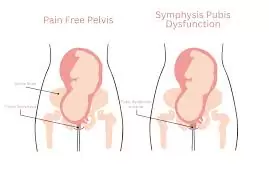ĐAU XƯƠNG CHẬU KHI MANG THAI