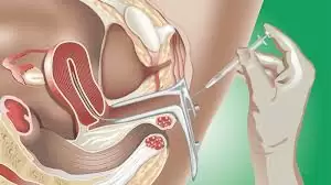 THỤ TINH NHÂN TẠO (IUI) – NHỮNG ĐIỀU CẦN BIẾT